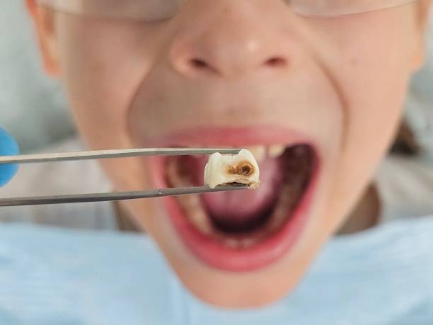 Best Emergency Wisdom Teeth Removal in Alma, GA
